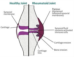 Rheumatoid-joint diagram compares healthy with rheumatoid graphic